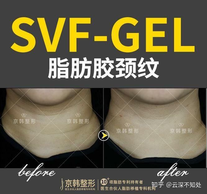 SVF脂肪胶 - 知乎
