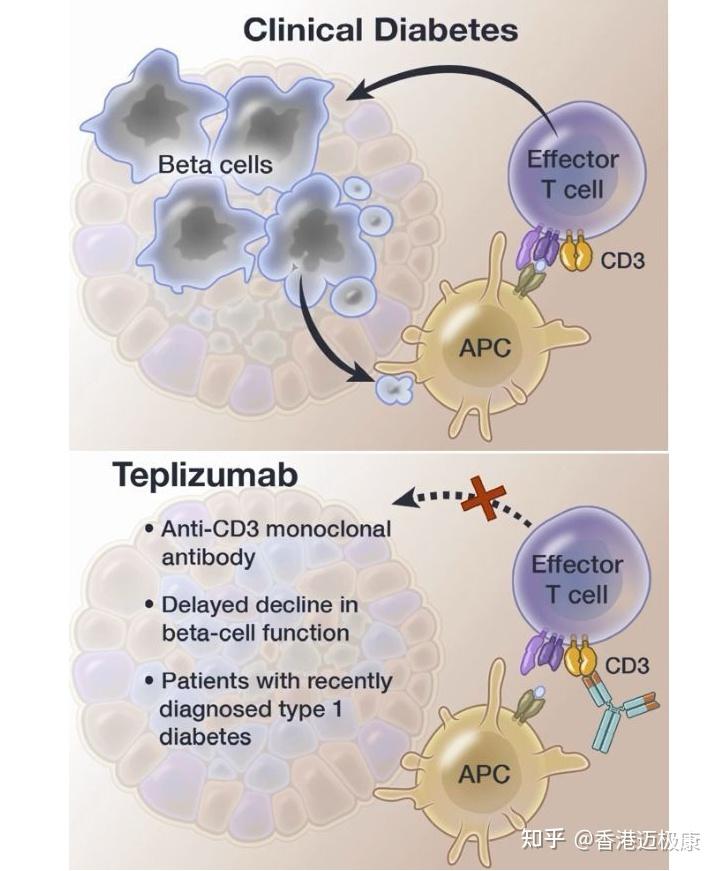 Provention Bio的1型糖尿病药物Teplizumab获得FDA批准 - 知乎