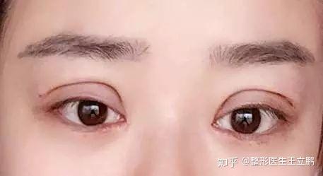 割双眼皮失败是什么样子的