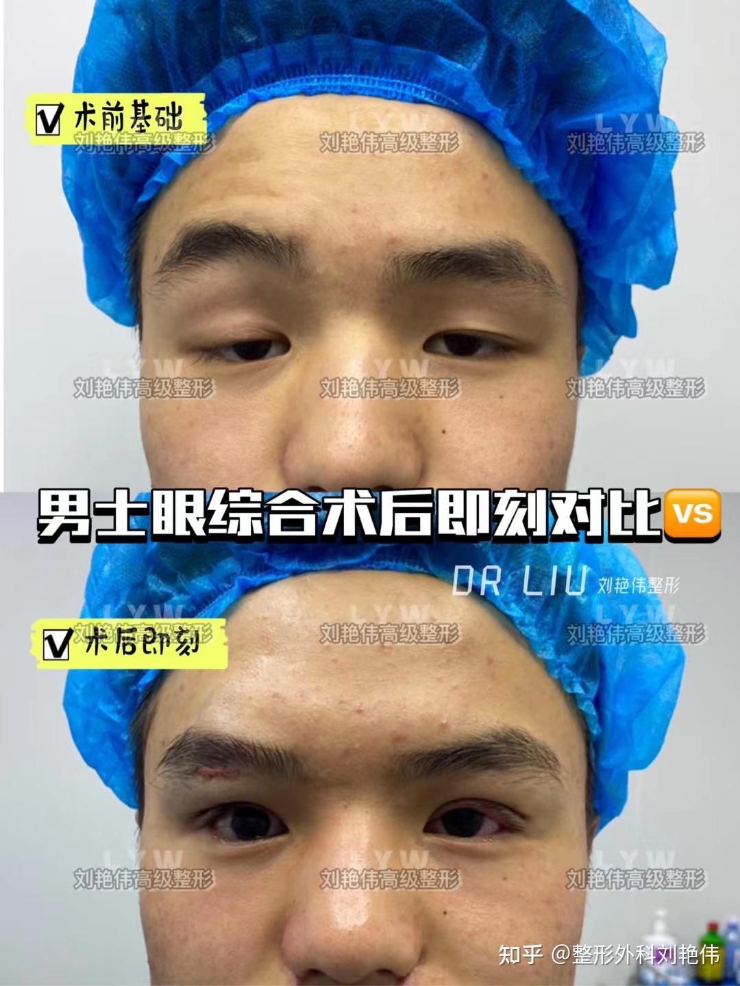 術後即刻男士#上瞼提肌無力# 矯正:你的眼睛有沒有上瞼下垂呢?