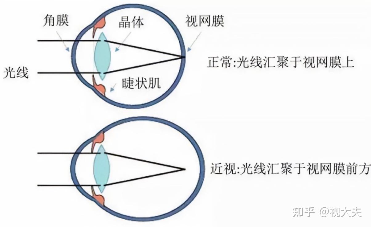 近视原理揭秘