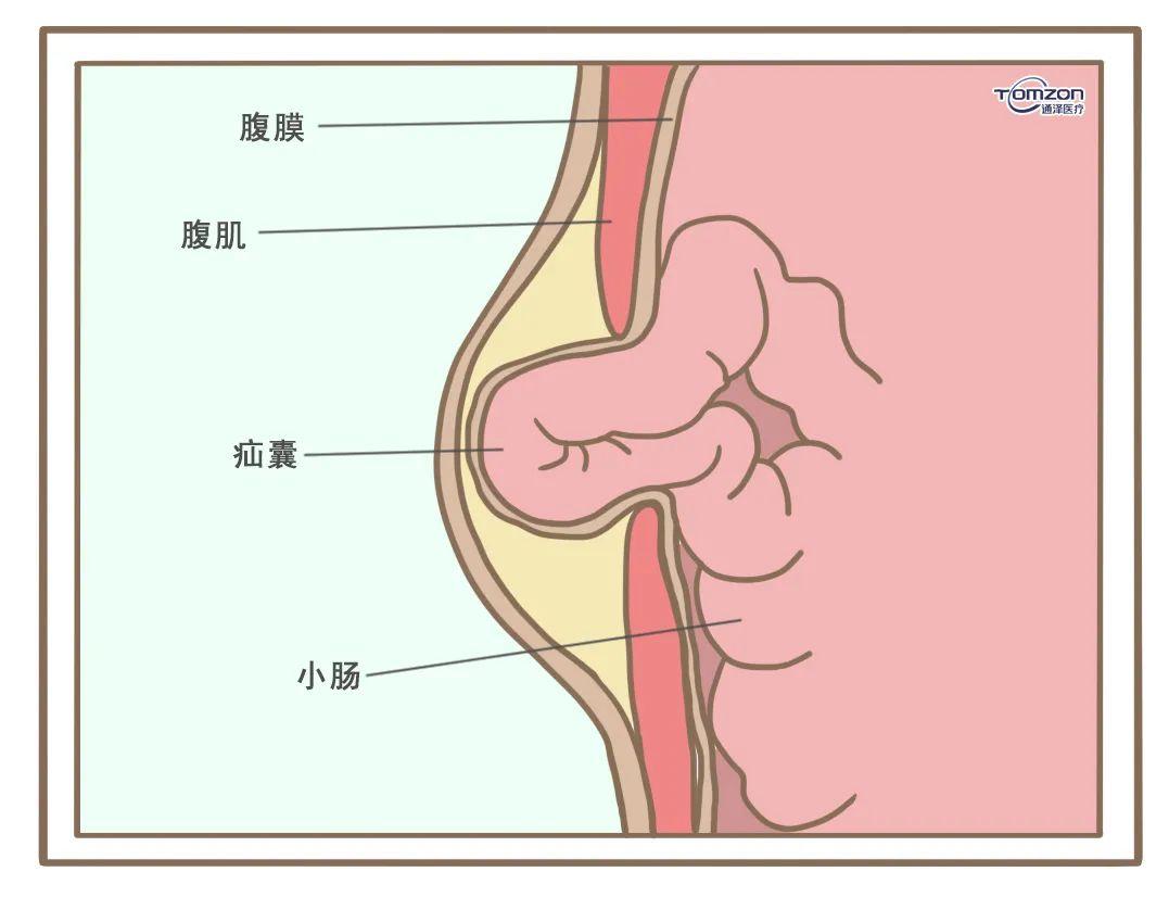 产后瘦了30斤依然被叫大肚婆到底哪一步出了错