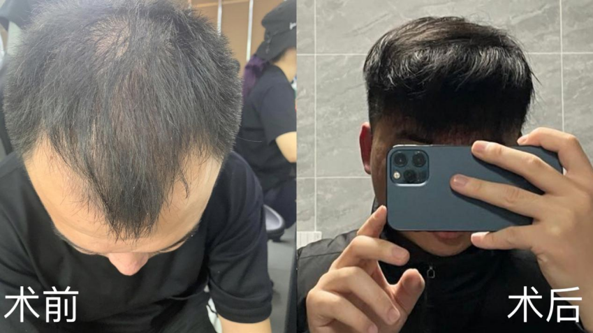 植发是不是骗人的？想植发成功是选择好技术重要还是选择好医院医生更重要？ - 知乎
