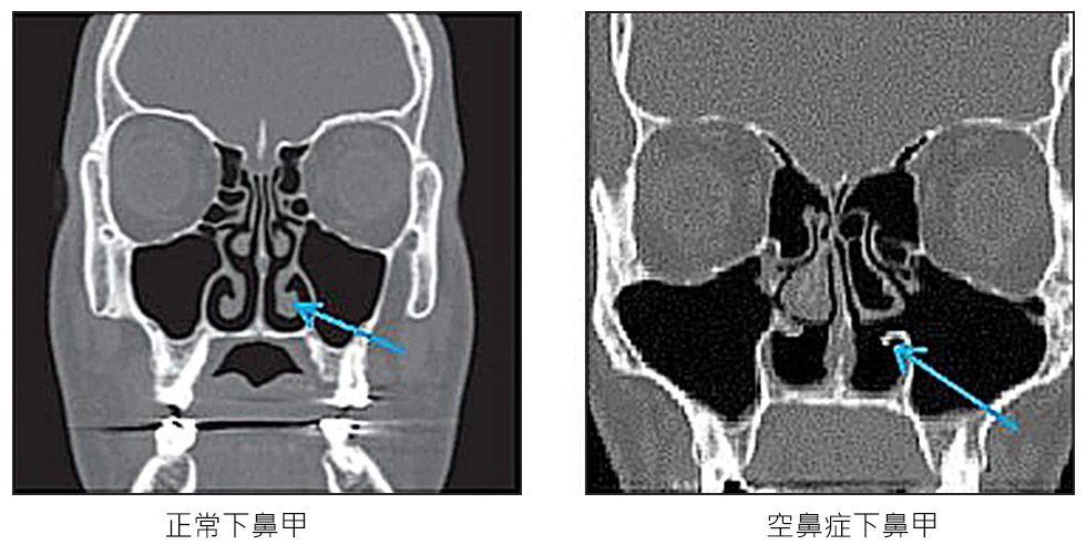 引发数起杀医事件的神秘空鼻症是医疗过失还是患者癔病