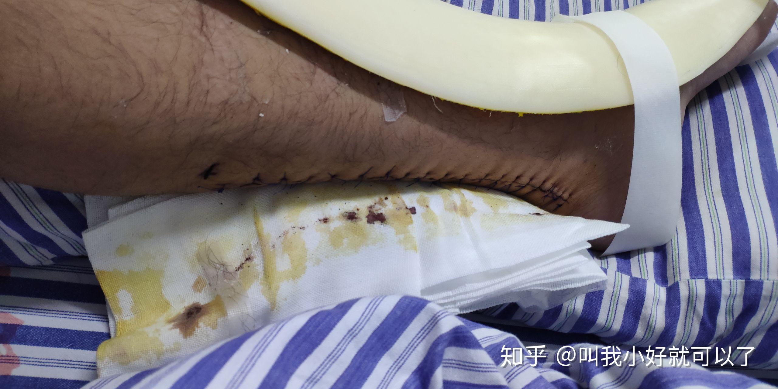 杜兰特亲自发文称跟腱断裂并且已接受手术这会给他之后的职业生涯带去