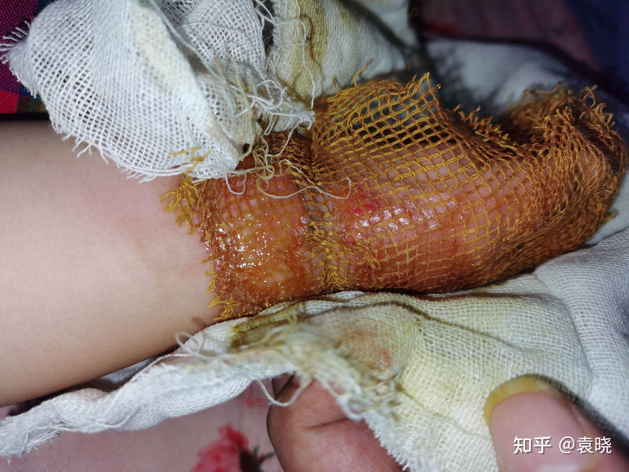 深二度浅二度烫伤1岁5个月中医治疗