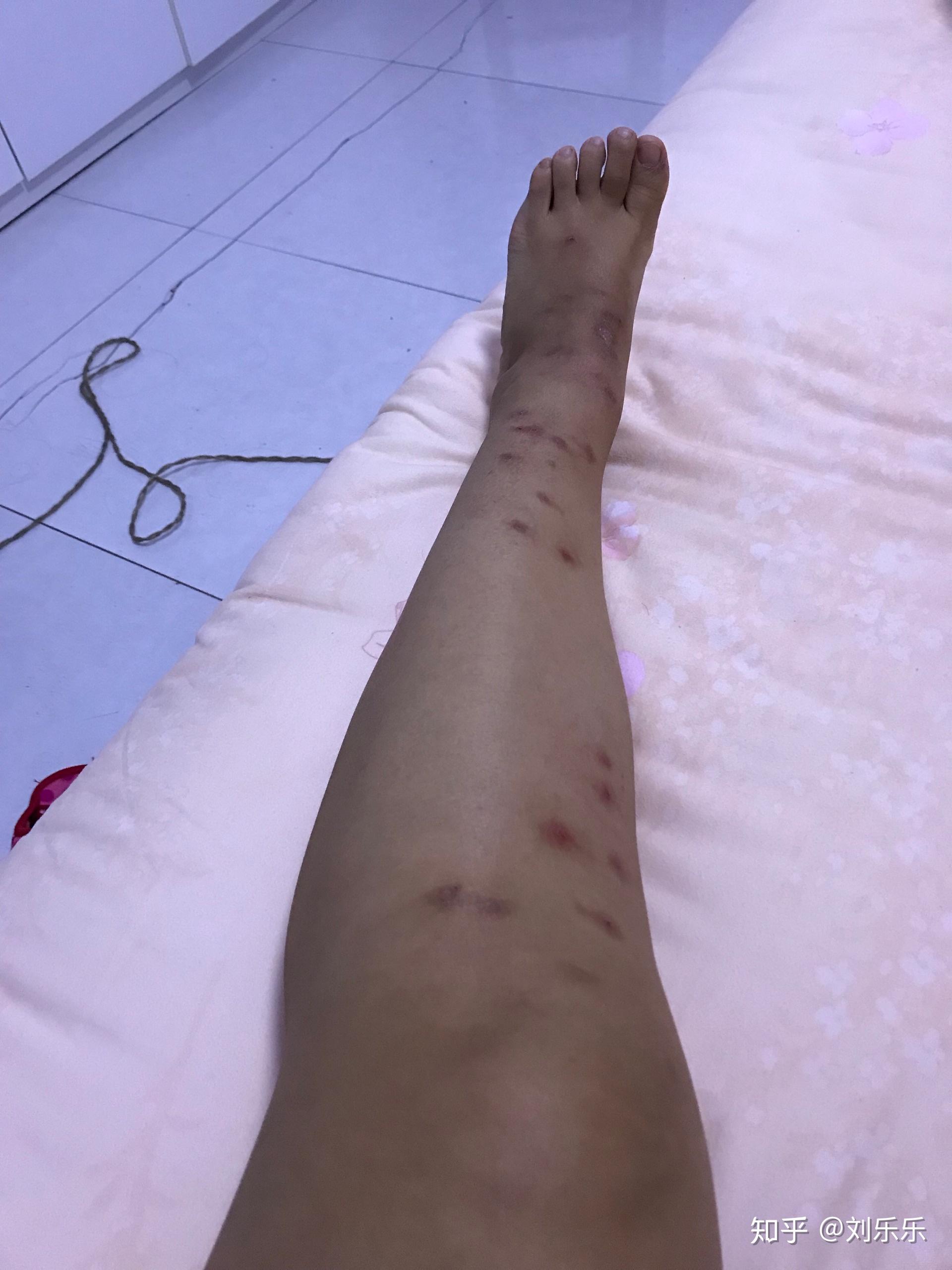 被跳蚤咬过的腿