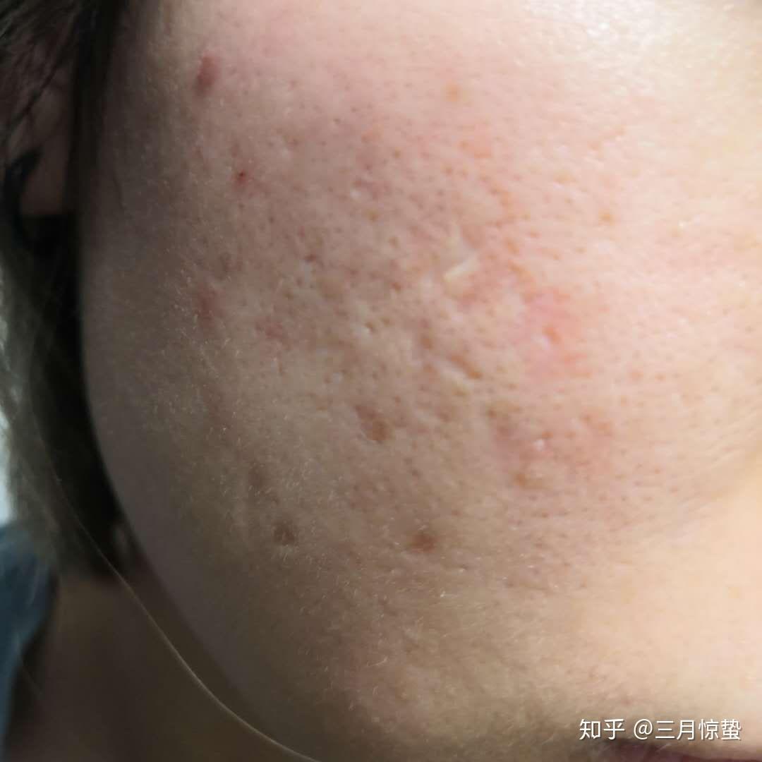 想在成都做激光祛痘坑,那里比较靠谱?有没有在