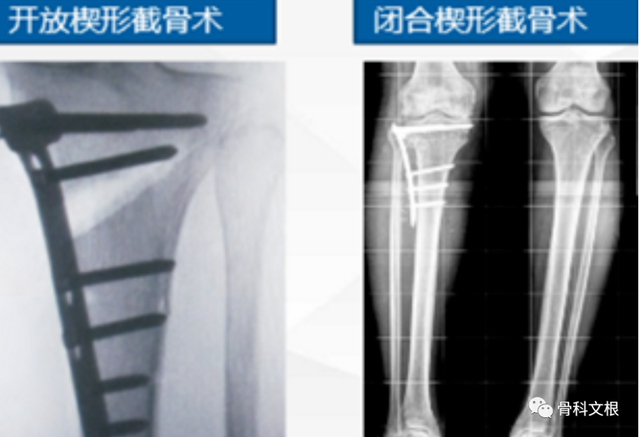 关于胫骨高位截骨术 Hto 你需要了解的八个问题 知乎