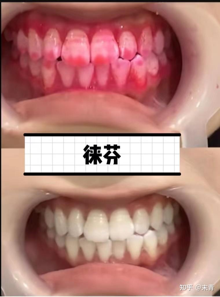 口腔护理必看2024电动牙刷5大品牌产品实测分析到底谁才是天花板