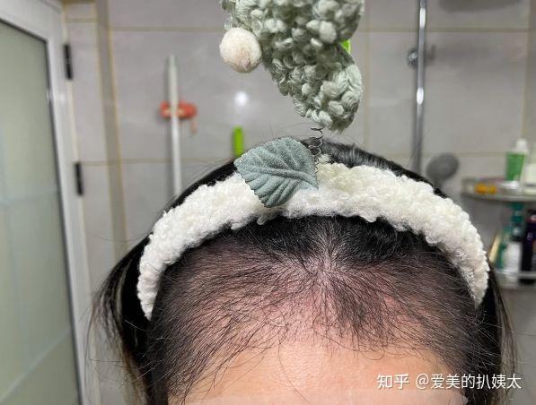 广州哪能植发(广州哪里有植发的正规医院)