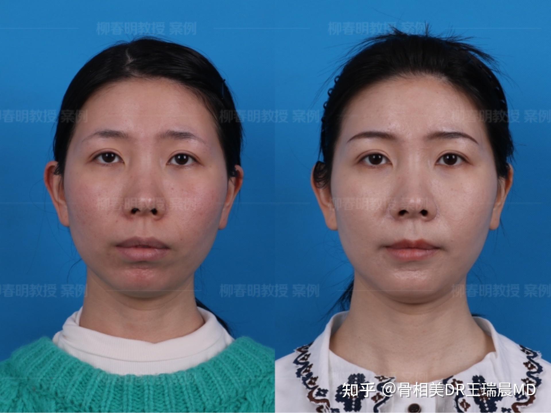 正颌手术案例分享双颌前突矫正术