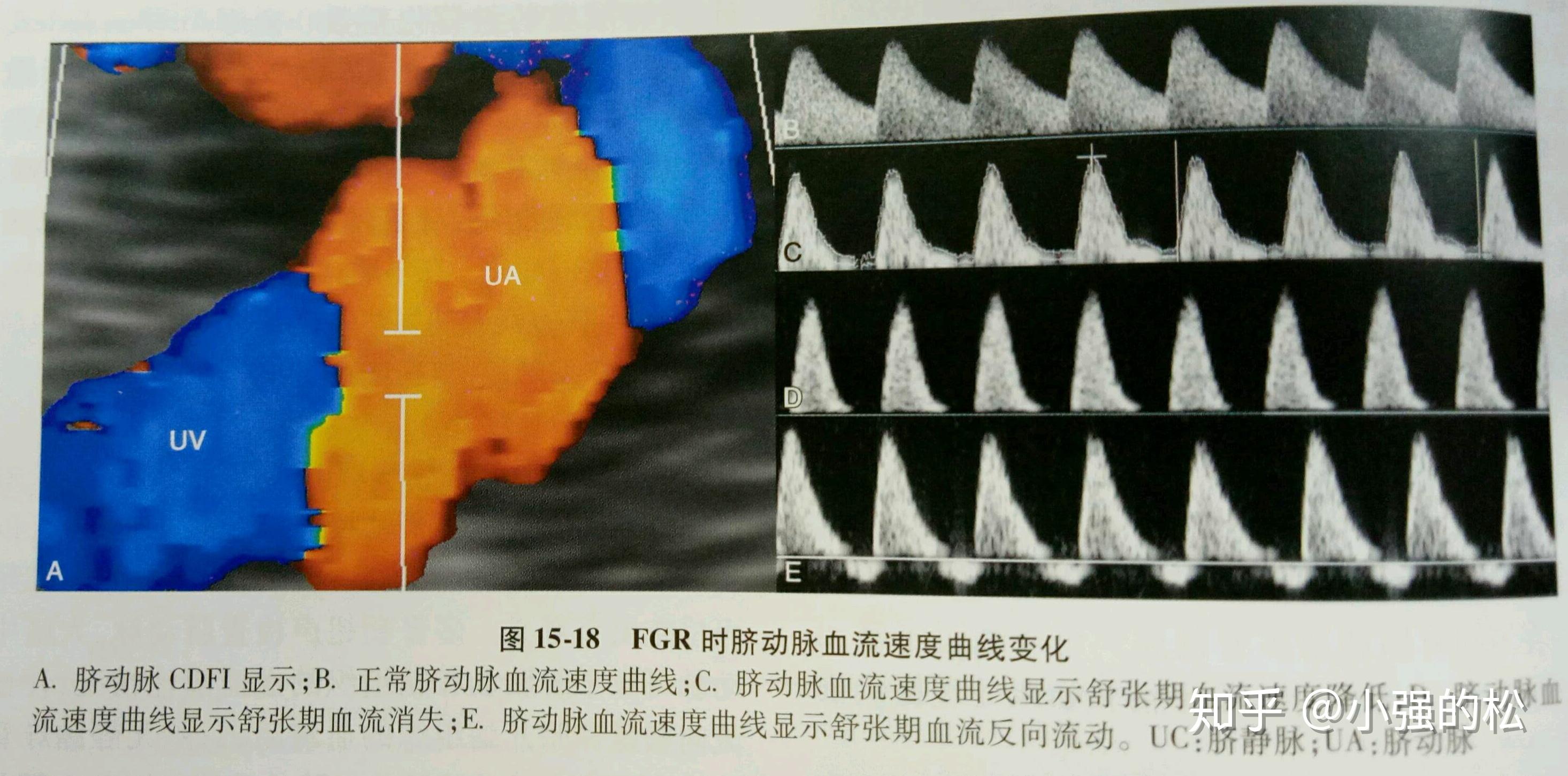脐血流 zhuanlan.zhihu.com