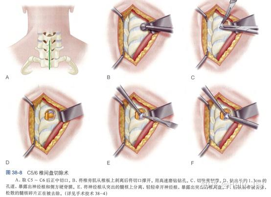 颈椎前路手术入路图解图片