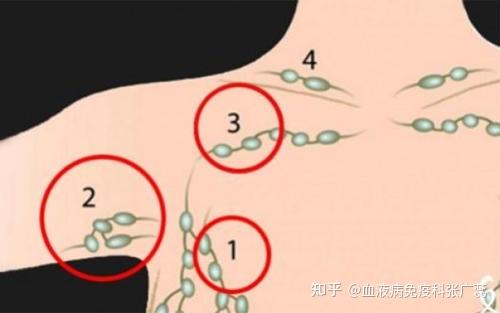 淋巴结为什么会出现这些情况你知道吗