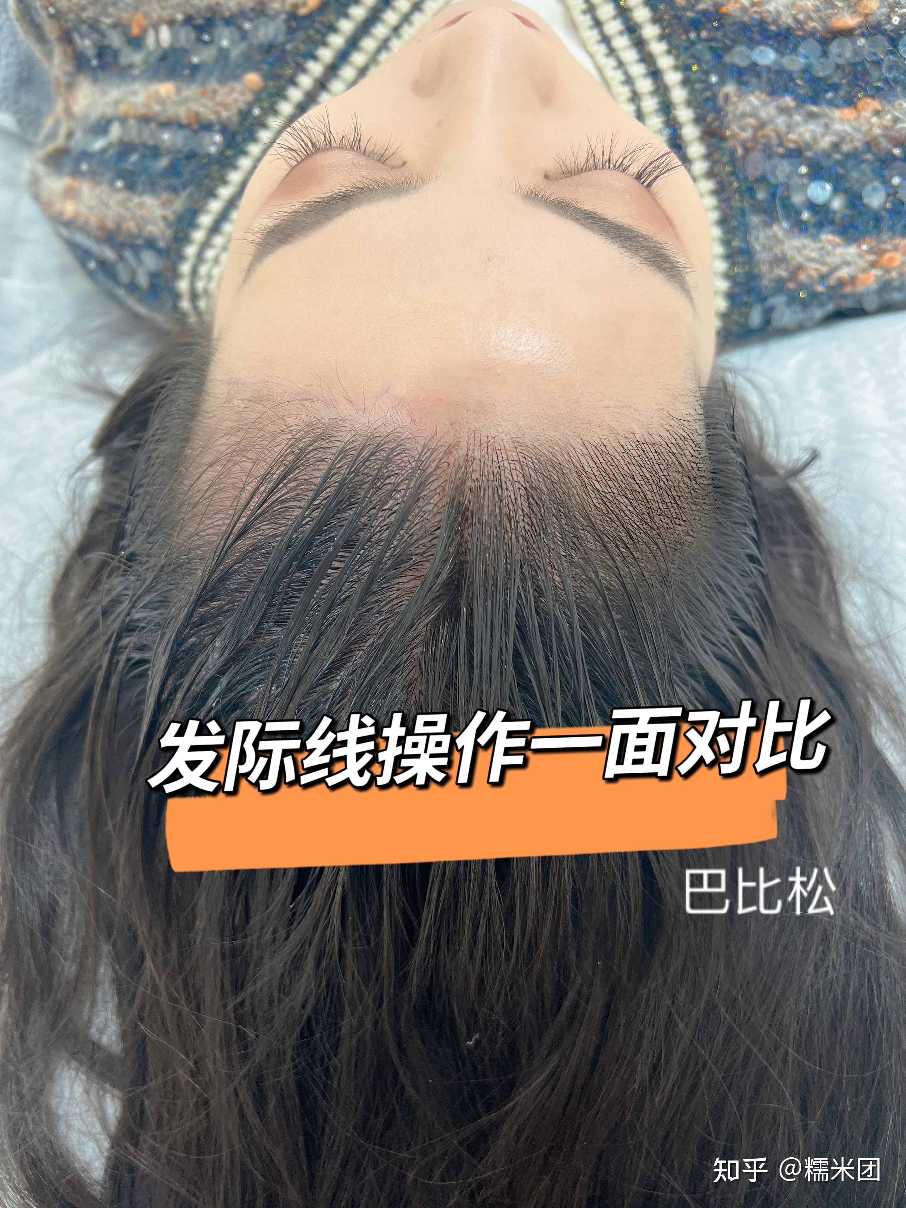 女人警惕你的发际线危机！来无锡纹发际线真的很重要 _远航纹身-站酷ZCOOL