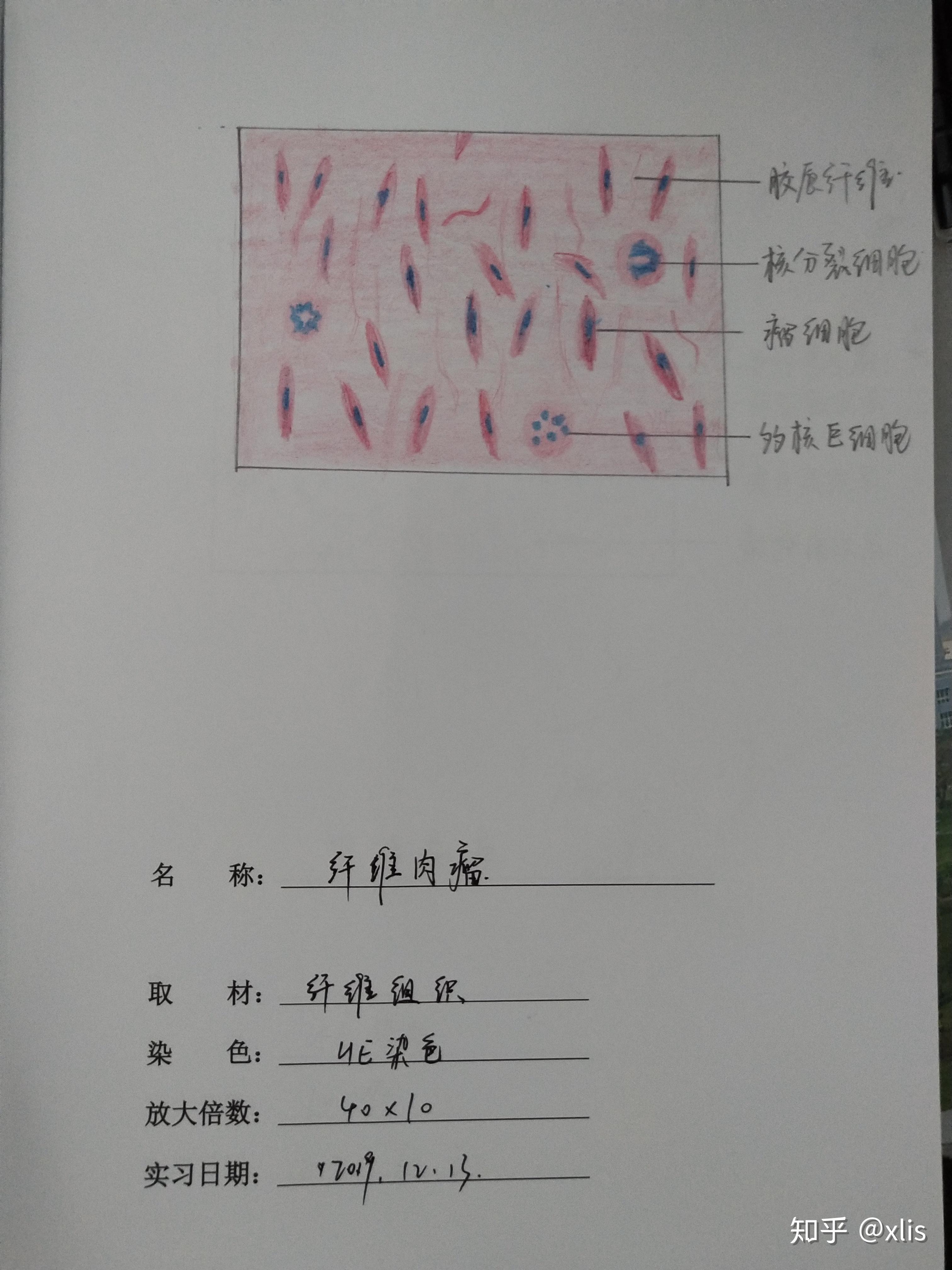 纤维肉瘤手绘图图片