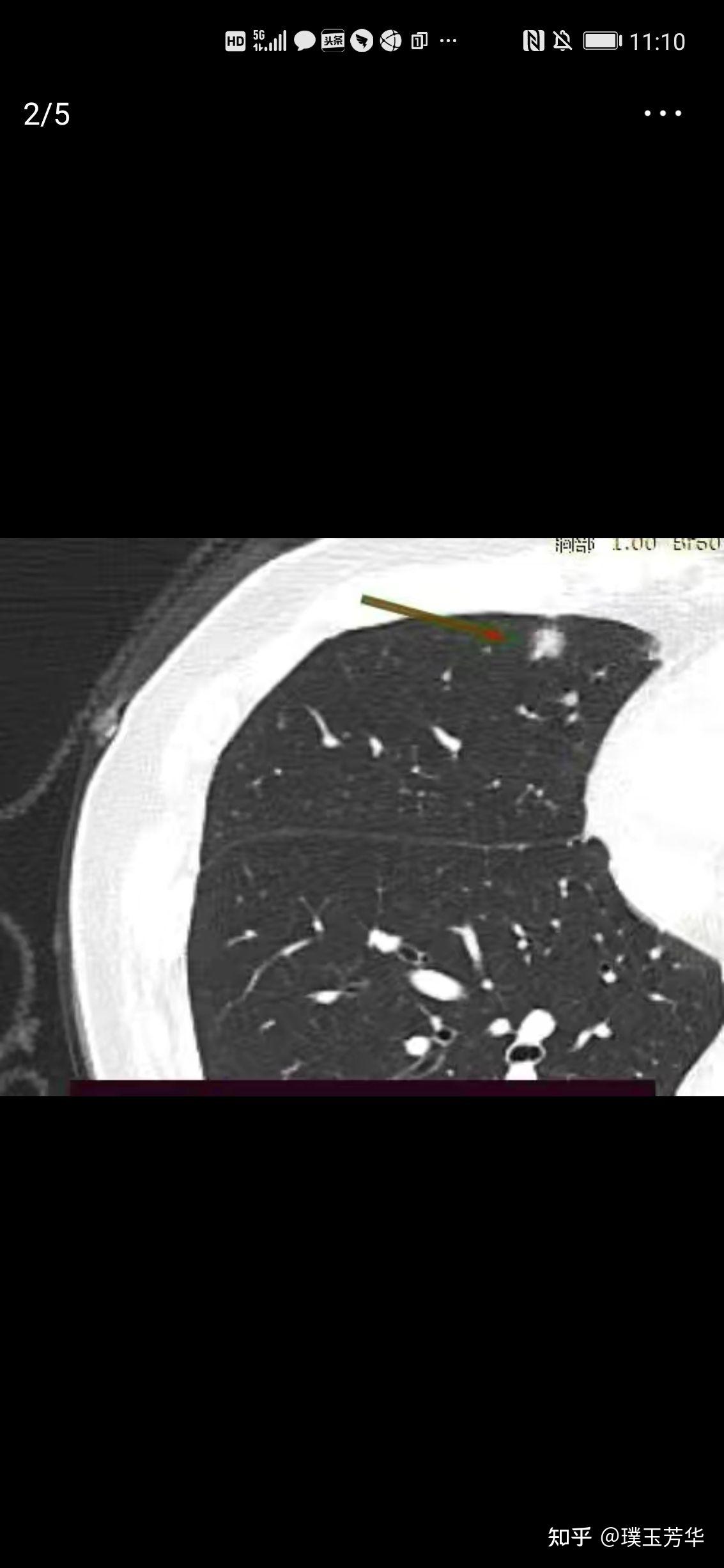 8mm混合磨玻璃肺结节当地建议做活检,我回复:手术不犹豫