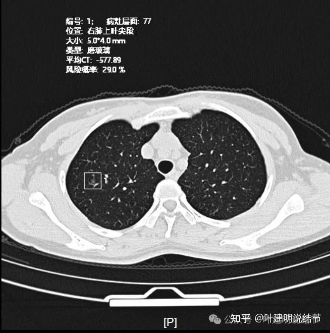 小叶中心结节示意图图片