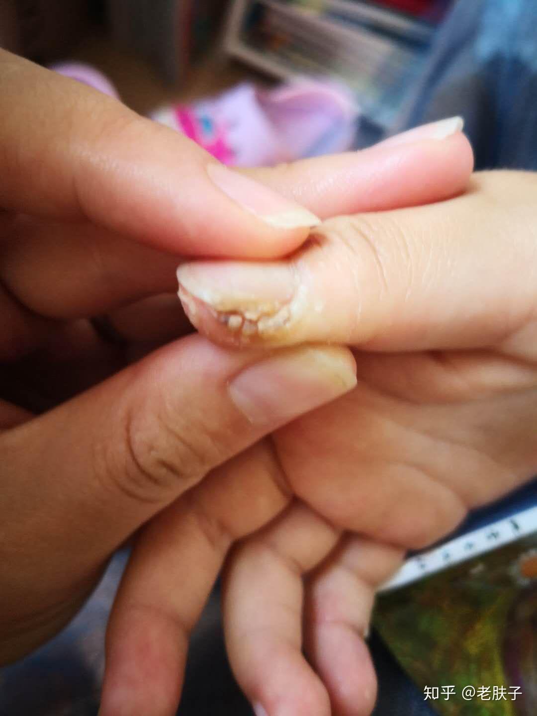 甲周疣怎么办 - 知乎