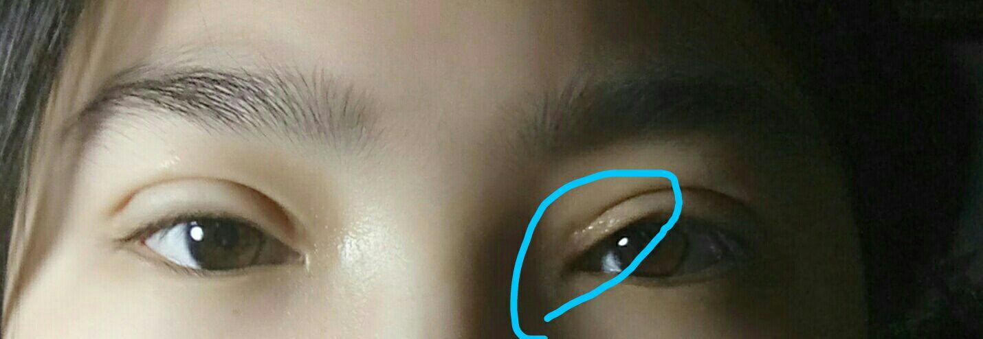 双眼皮手术后一只眼睛前面部分下垂,很不自然