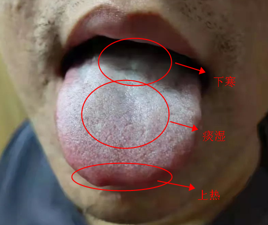 一招识别上热下寒的舌象张仲景一方清上温下交通心肾