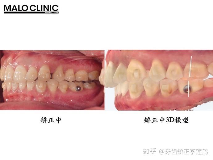 北京牙齿矫正丨嘴突、闭唇紧张、深覆合,隐适美推磨牙向后 - 知乎