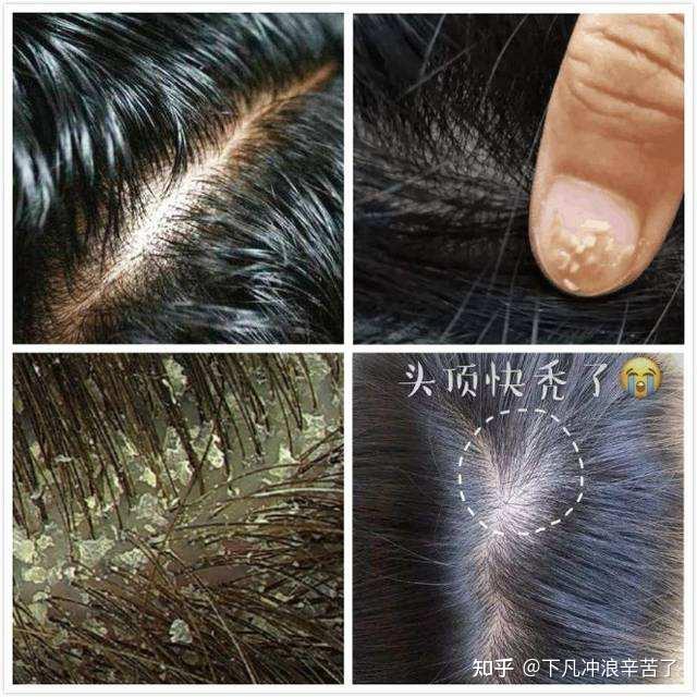 而且頭蟎生活在頭皮上,能進入毛髮根部,普通的洗髮水是很難起到作用的