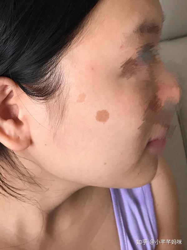 今天准备来激光祛老年斑了会坚持更新一年了已恢复有最新照片