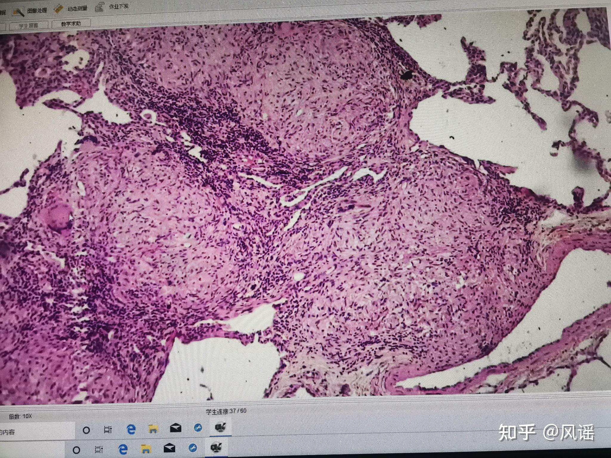 肺结核:中央为干酪样坏死,周围是上皮样细胞,有朗汉斯巨细胞,结核结节