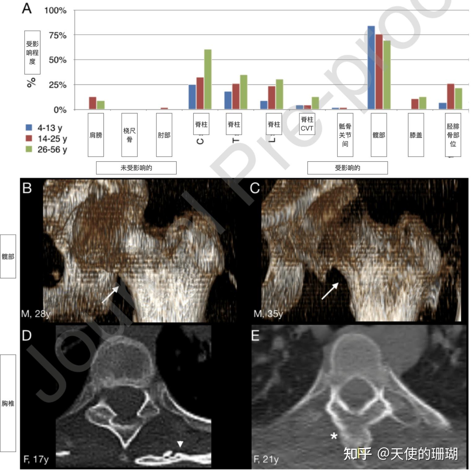 Fop Pathogenesis FOP患者的骨骼畸形与发育性关节疾病 - 知乎