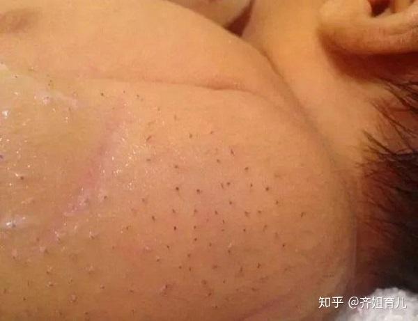 如果采用搓,揉或拔除等办法强行褪去宝宝的毳毛,轻微的会引起毛囊发炎