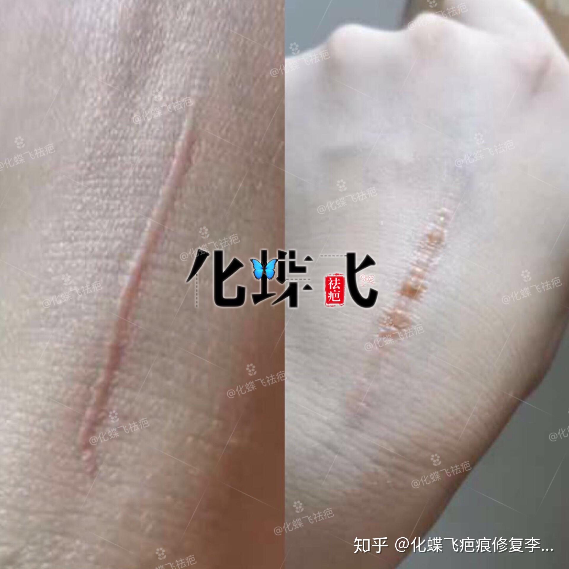 医院外科工作的小姐姐也用中药修复疤痕增生