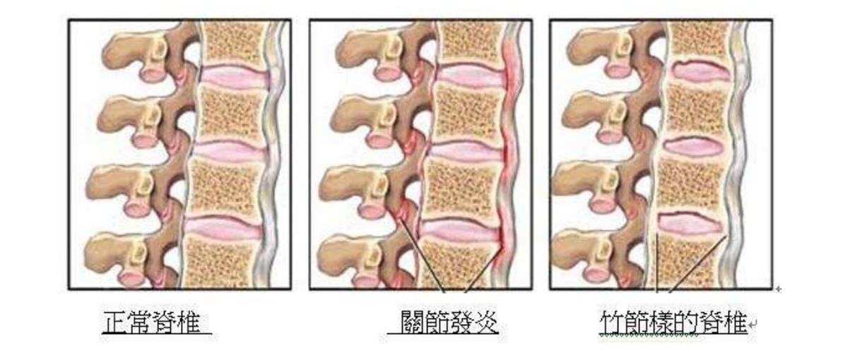 as故事患強直性脊柱炎40年風雨人生路生活依舊充滿期待連載4