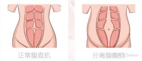 「产后恢复」都包含哪些项目,需要注意什么?