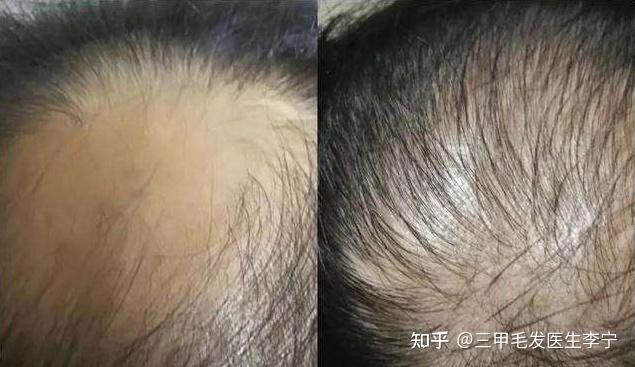 毛囊干细胞生发前后案例对比图 - 知乎