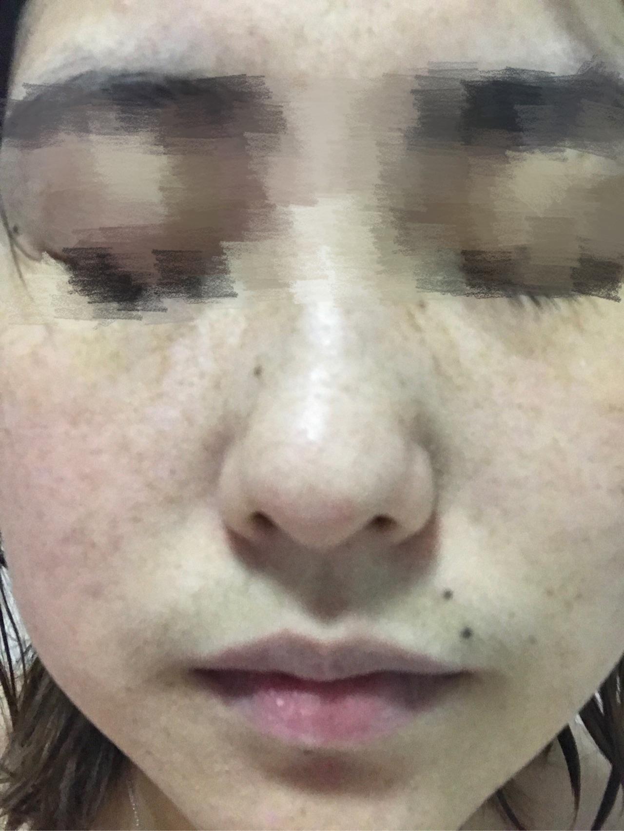 怎么去雀斑,激光祛斑怎么样?