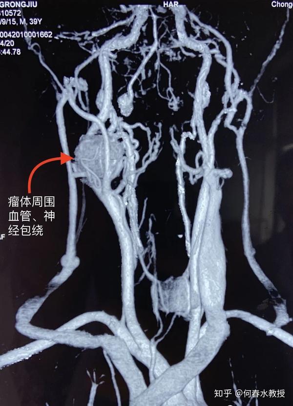 一例高难度颈动脉体瘤切除术