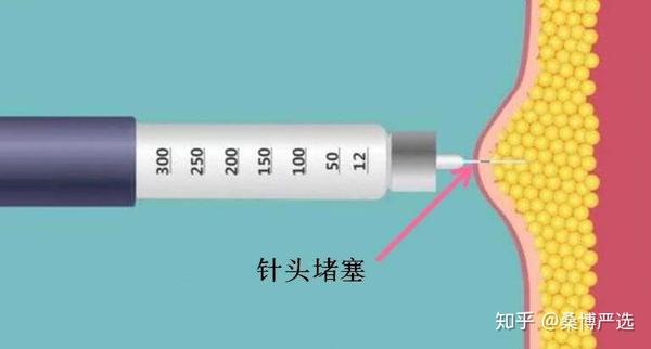 注射胰島素方法不對療效減半,早知道早獲益