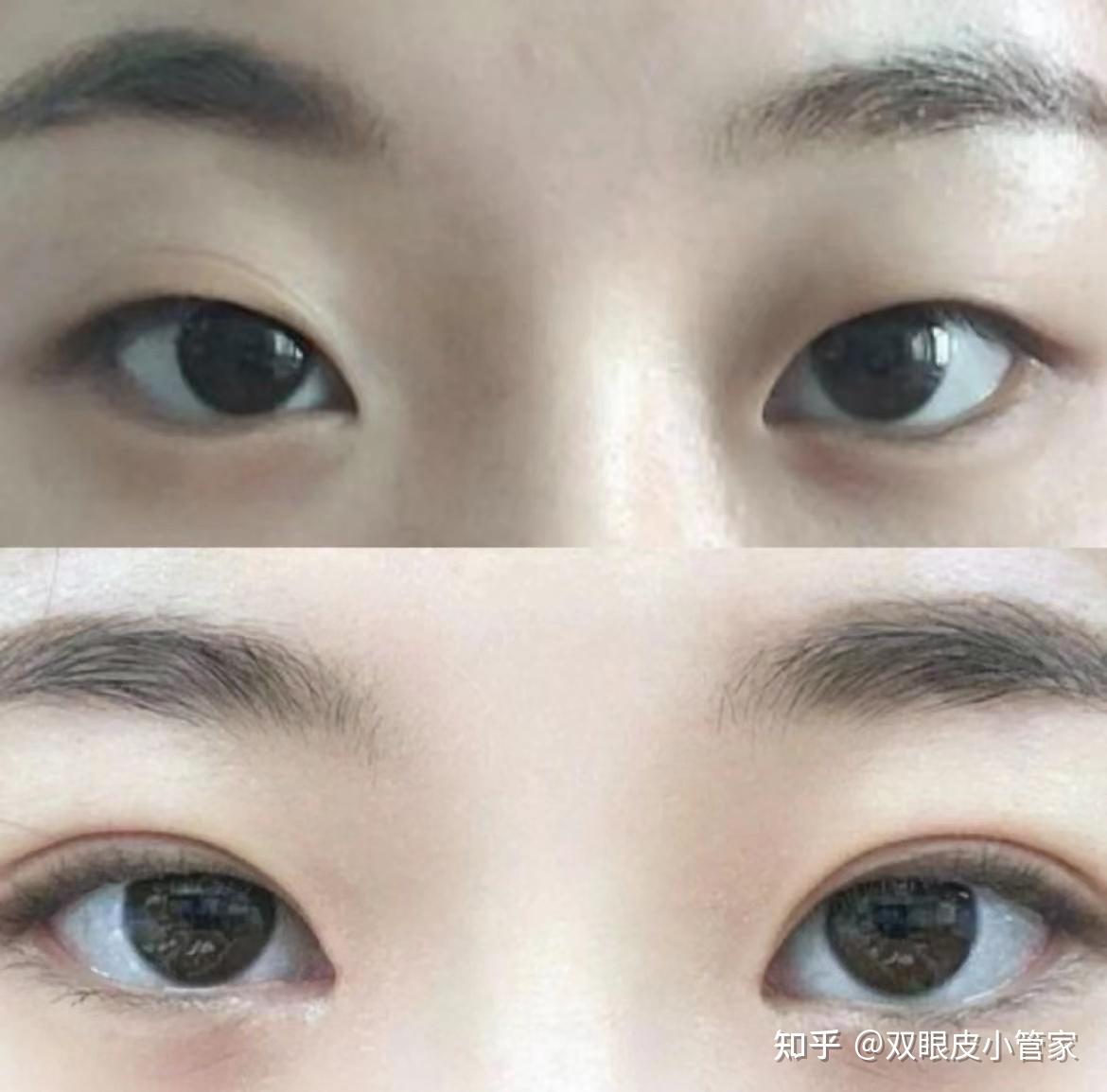 北京双眼皮经常被问到和选择的医生 - 知乎