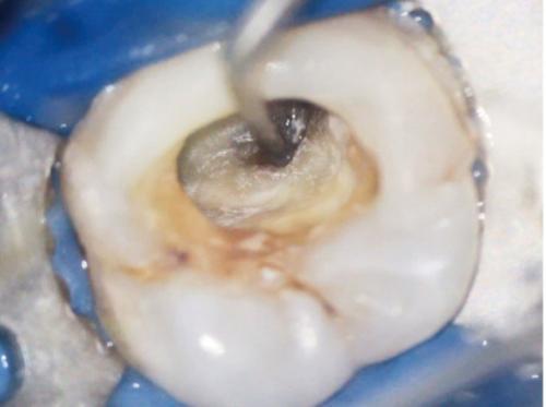 简单来说,牙髓钙化是指牙