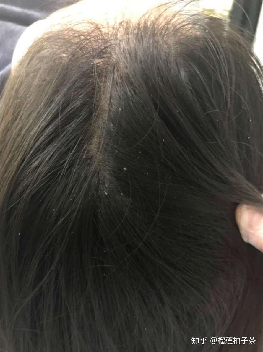 每次洗完头后当天反而头屑特别多是什么原因如何解决