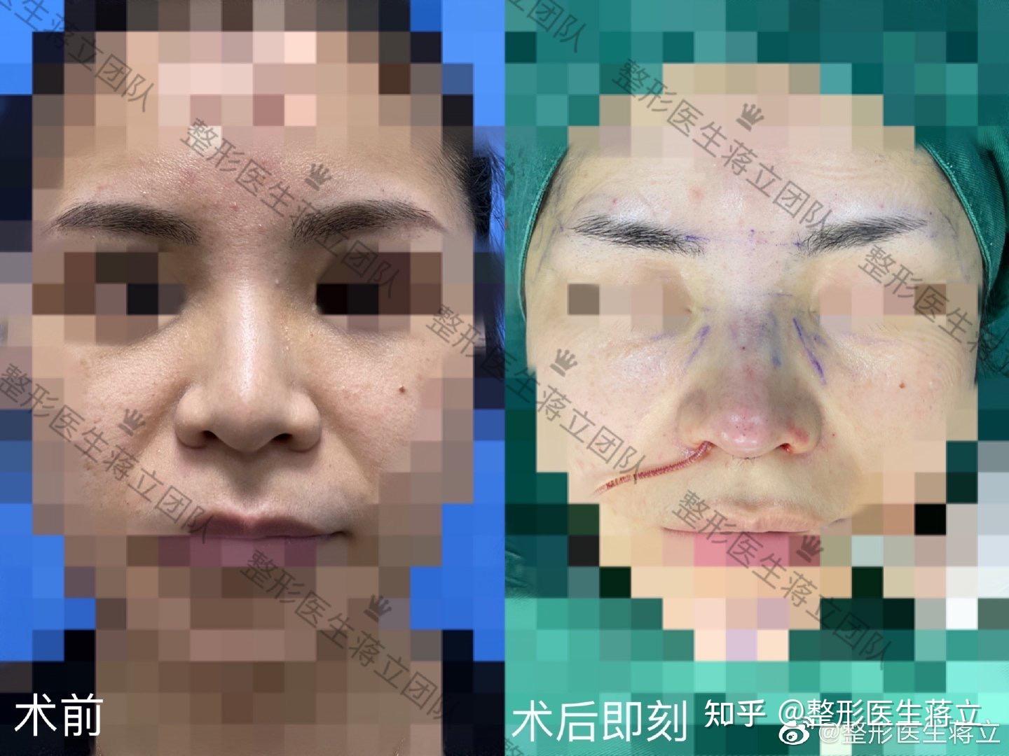 中面部、鼻基底凹陷,鼻头圆钝缺少表现点,鼻骨宽,鼻翼缘退缩,塌鼻,鼻翼高低不齐。 - 知乎