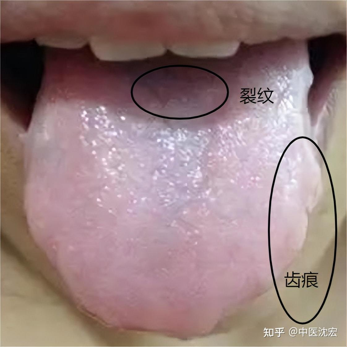 阳气不足舌先知，舌头上这些特征越多，你阳虚的就越厉害了 - 知乎