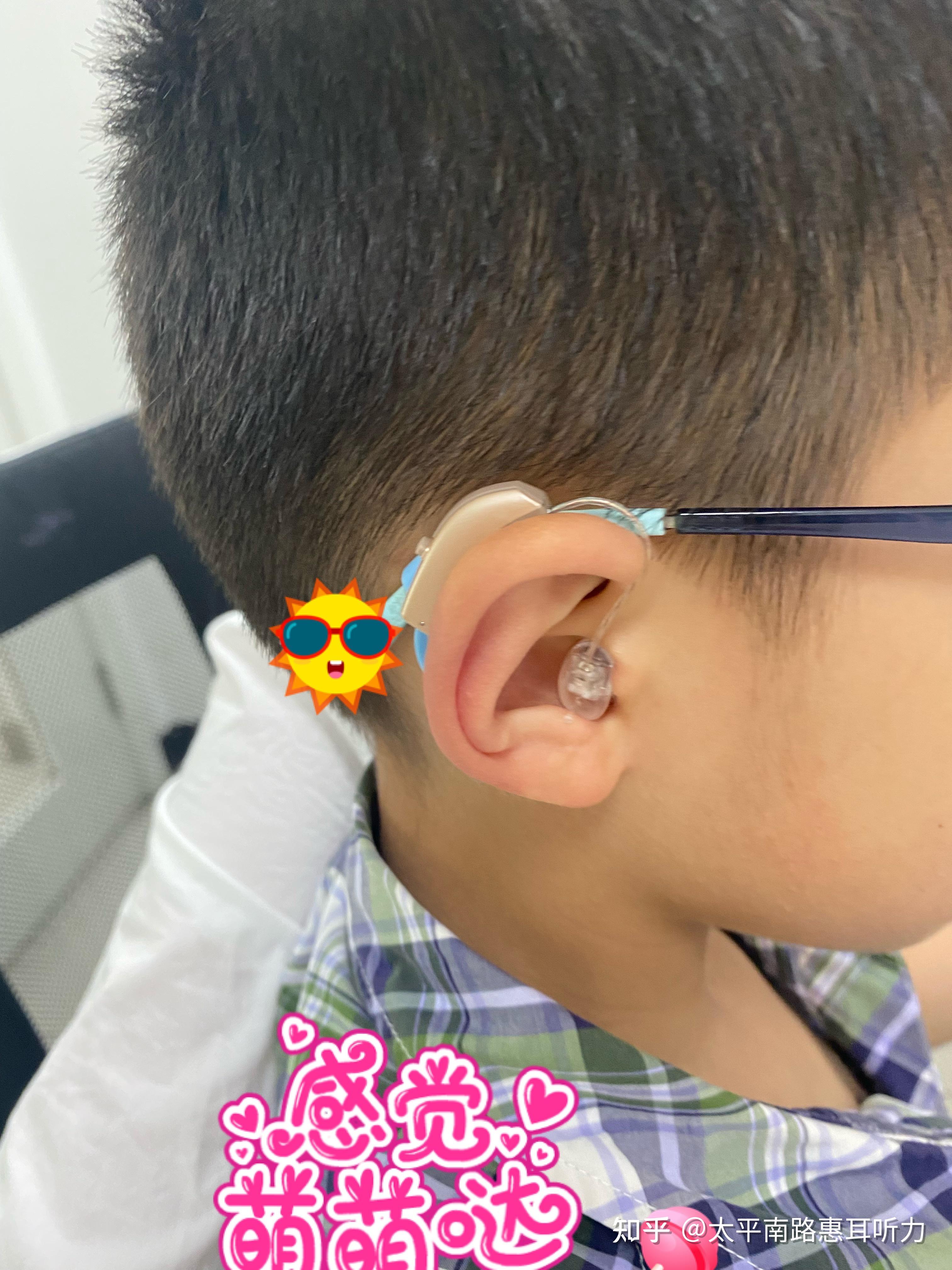 儿童助听器佩戴效果图图片