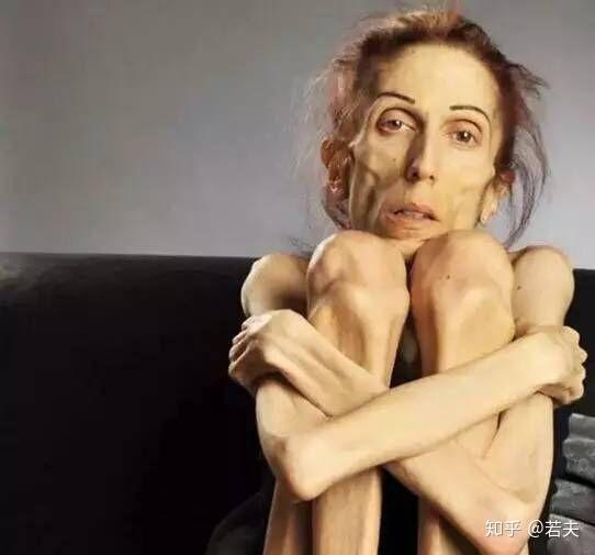 附上一张厌食症患者图片,如下然后我搜索了一些关于这个病症患者的