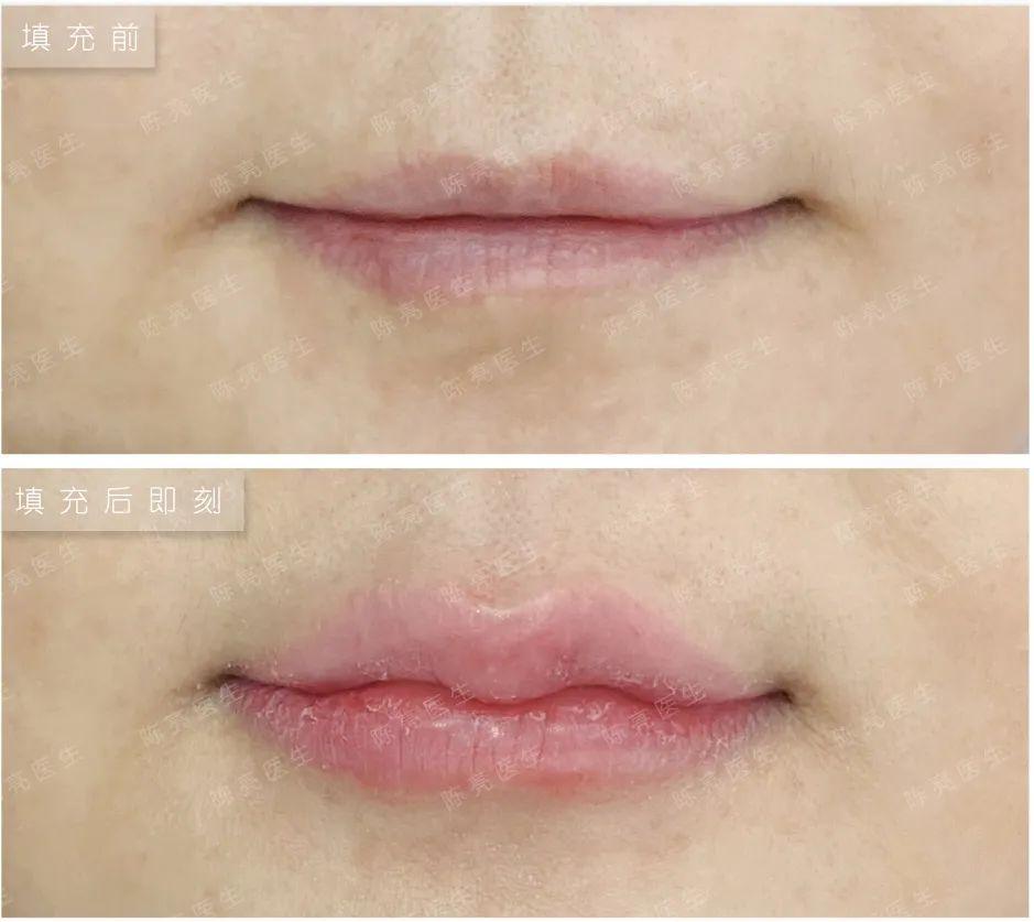 必看干货维持玻尿酸效果的妙招来了