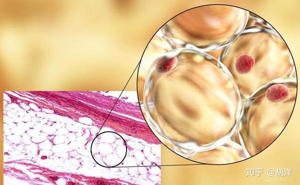长满全身的脂肪瘤会恶变吗 脂肪肉瘤是不是脂肪瘤恶变而来的 知乎