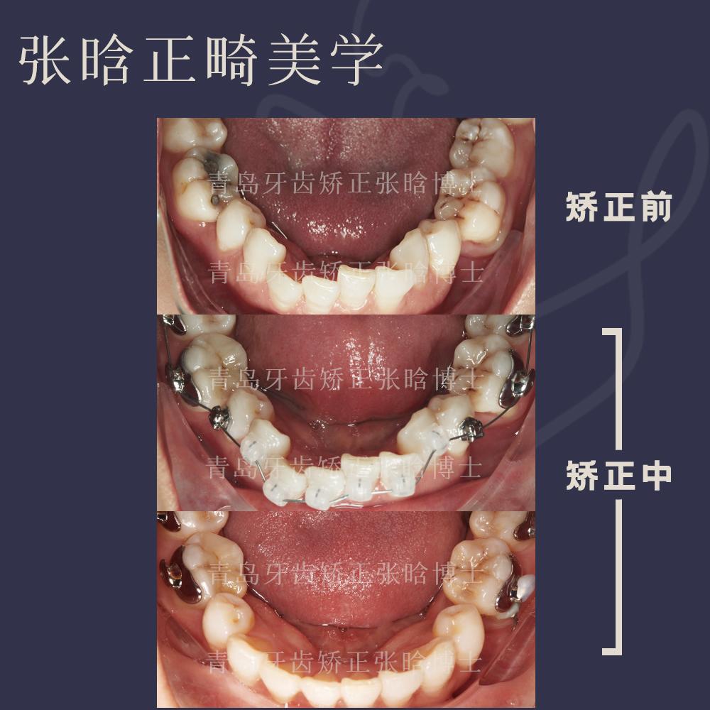 青岛牙齿矫正 | 重度张口受限、牙列不齐陶瓷 舌侧矫治 - 知乎