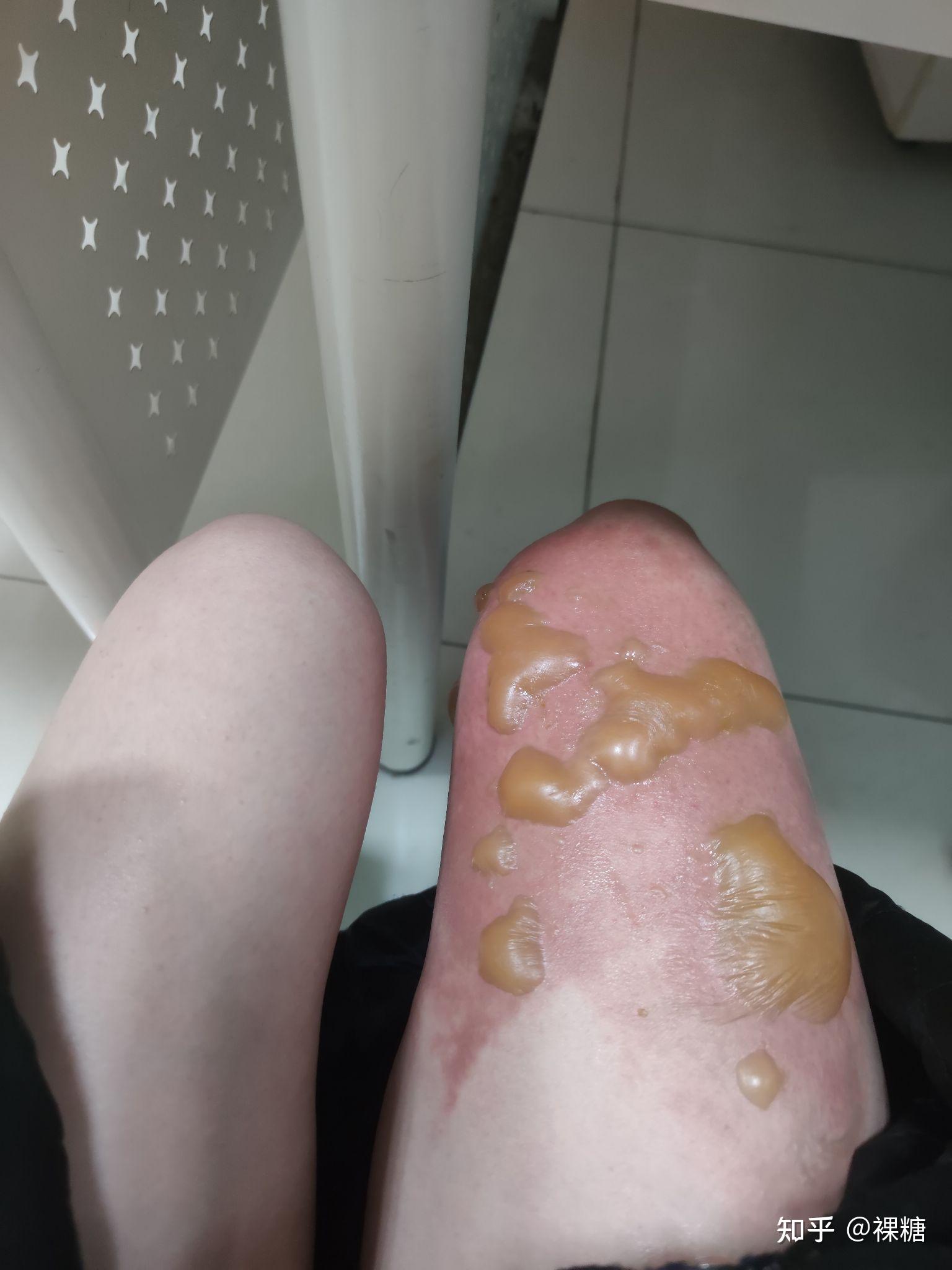 第二天水泡肿老大因为没有及时冲洗,加上穿的衣服厚,导致烫伤程度不